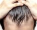 Hair-Fall-treatment-kudasan-gandhinagar-hair-growth